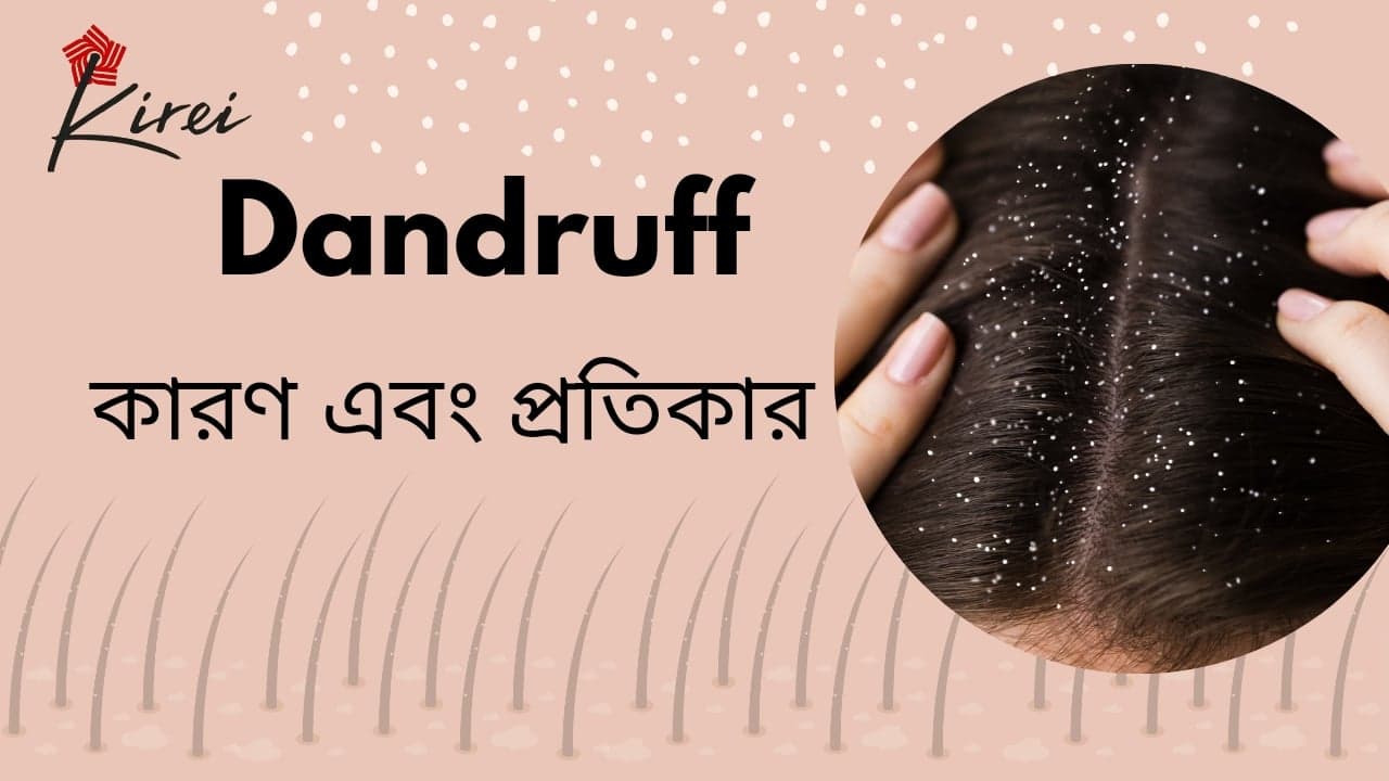 Dandruff: কারণ ও প্রতিকার
