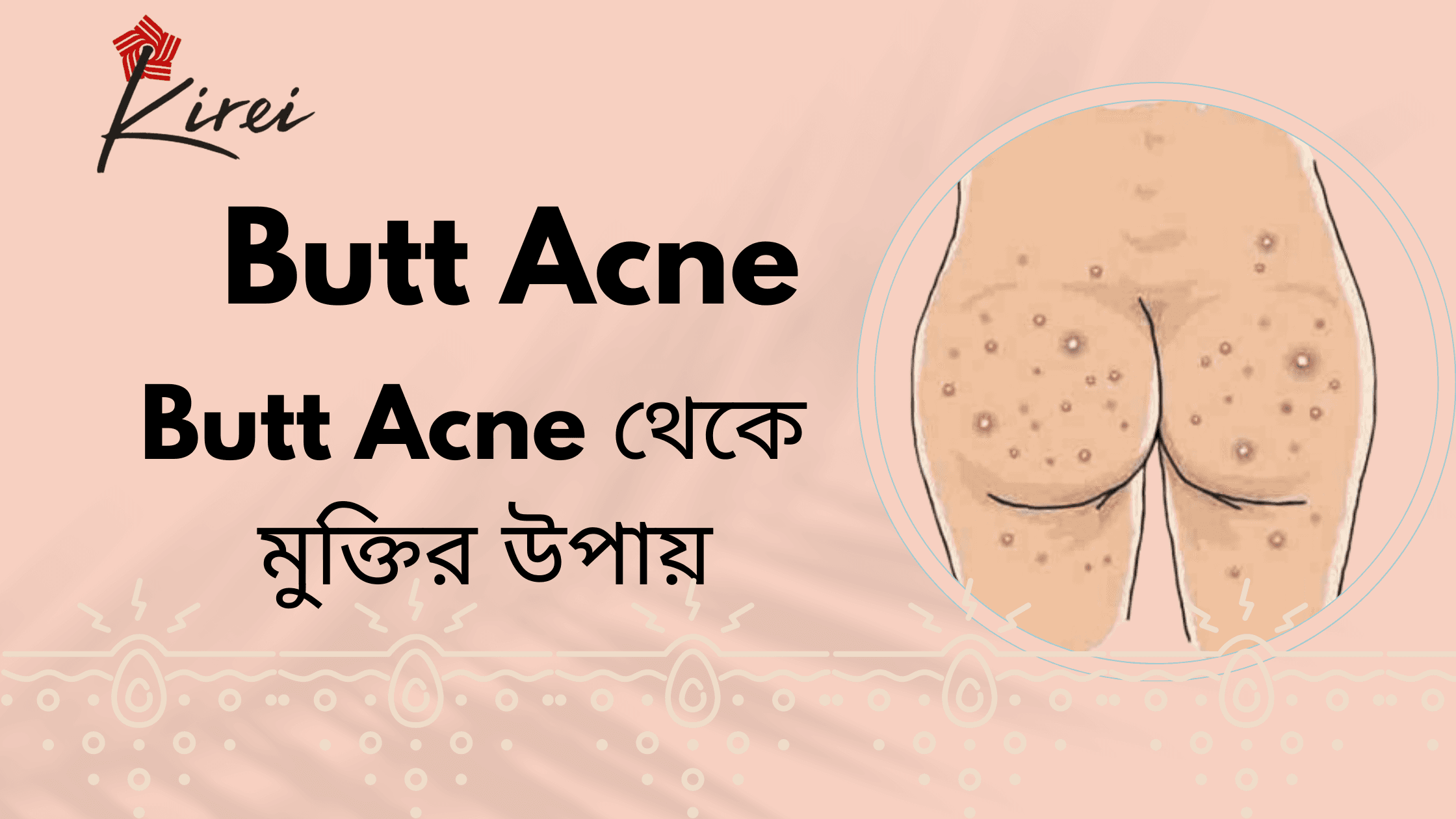 Butt একনি থেকে মুক্তির উপায়