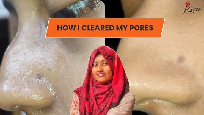 How I cleared my pores