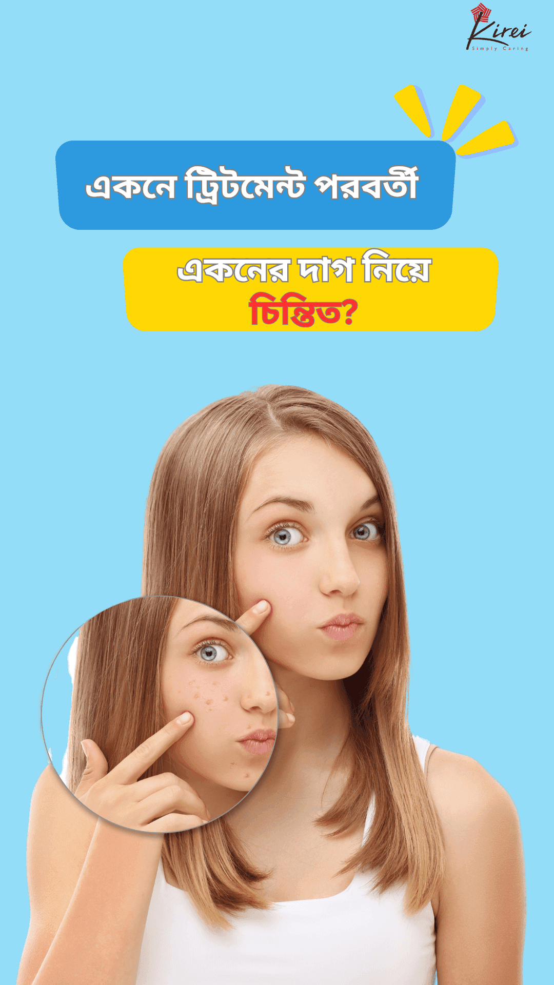 একনে ট্রিটমেন্ট এর পরবর্তী একনে দাগ নিয়ে চিন্তিত?